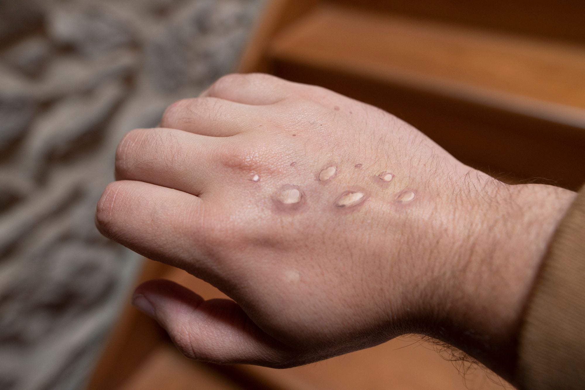 SF Reports First 'Probable' Case of Monkeypox; Possibly Infected Resident Had Traveled to Area With Known Cases