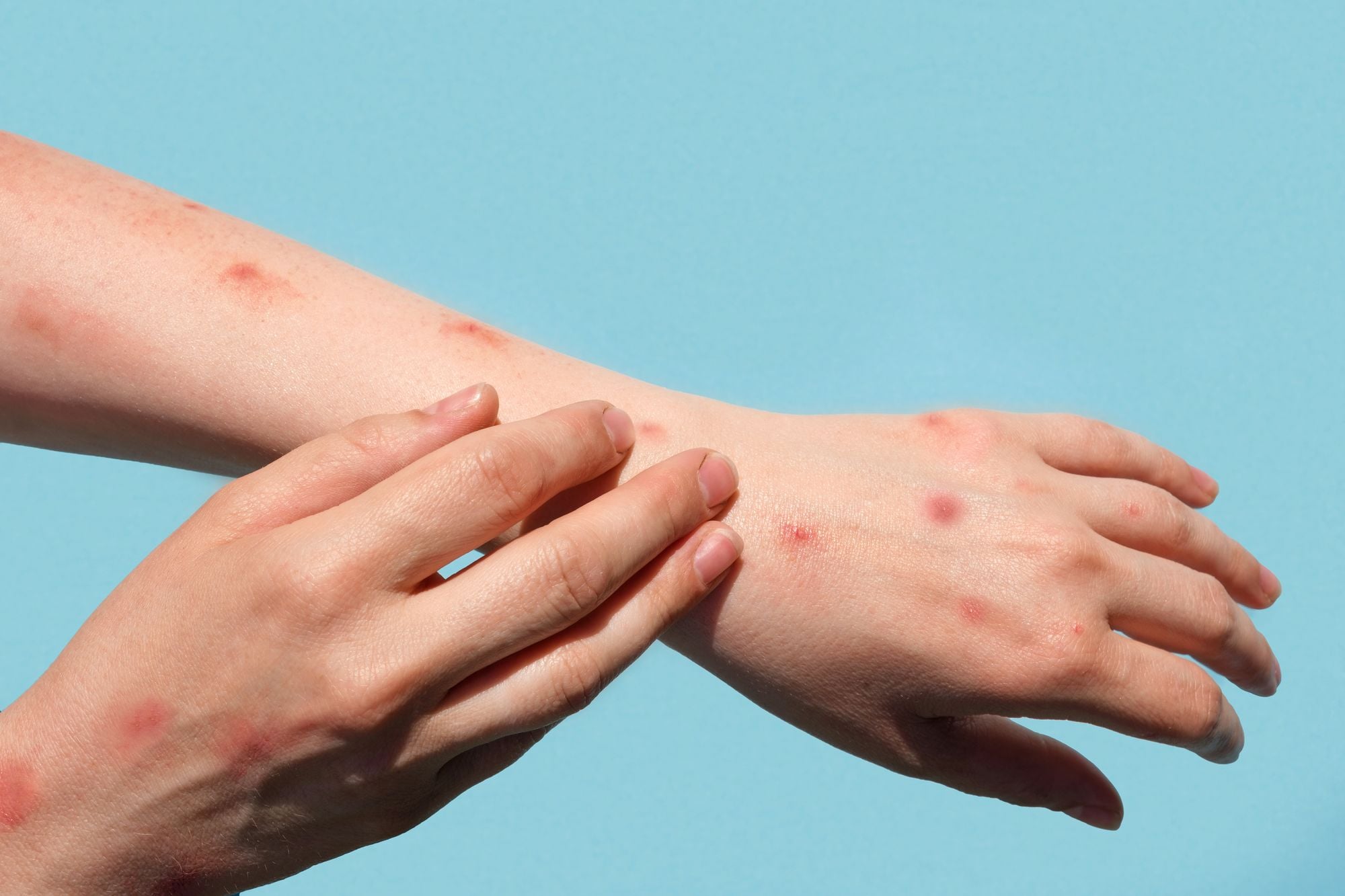 SF Officially Declares State of Emergency Over Monkeypox