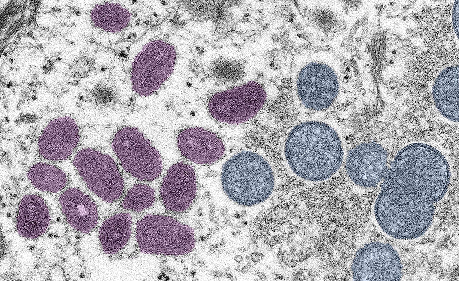 With Monkeypox All But Disappeared Locally, SF Will End the Public Health Emergency Next Week