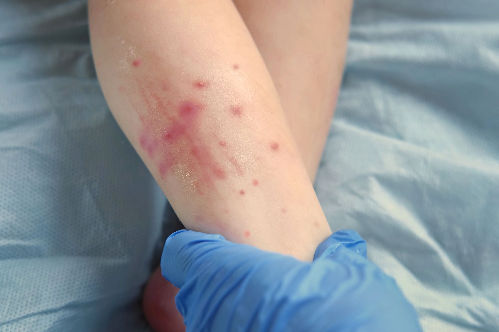 Possible Measles Exposure Reported at San Leandro Restaurant