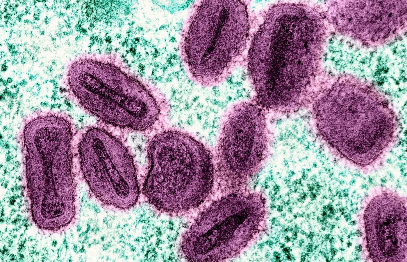 SF Resident Contracts New Strain of ‘Mpox,’ But Risk Still Low