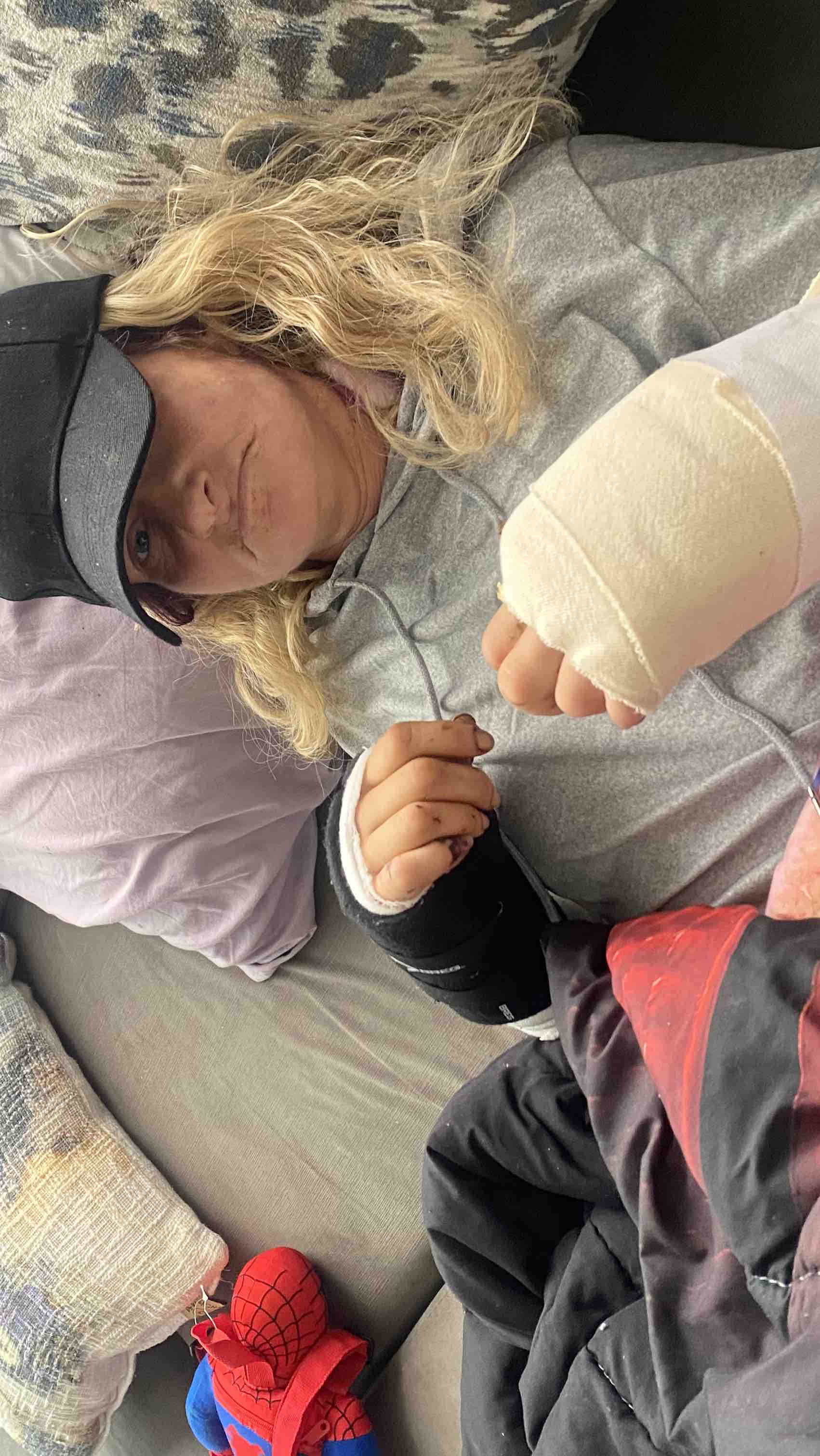 A blond woman with bandages on both hands wearing a black baseball cap lying down, looking at the camera.